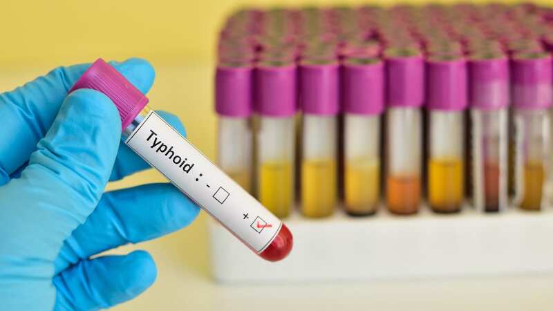 A blood sample with typhoid disease inside as fears it could resurge (Image: Getty Images/iStockphoto)