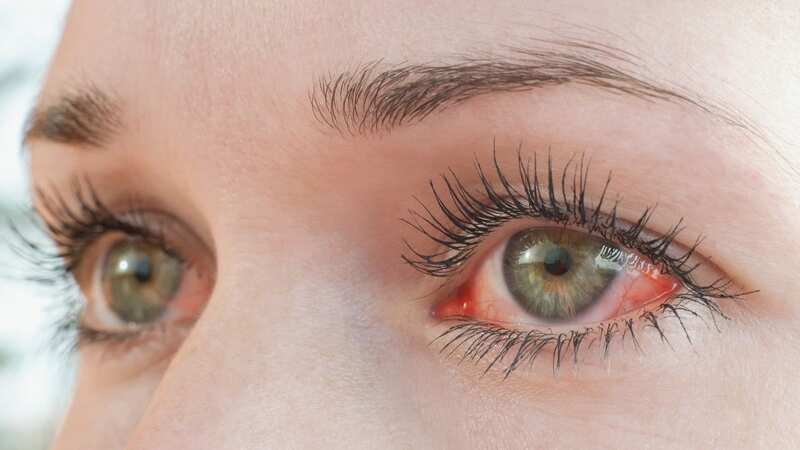 CCHF can cause bleeding rashes on mucosal surfaces such as the eyes, eyelids, ears, inside the nose (Image: Getty Images)