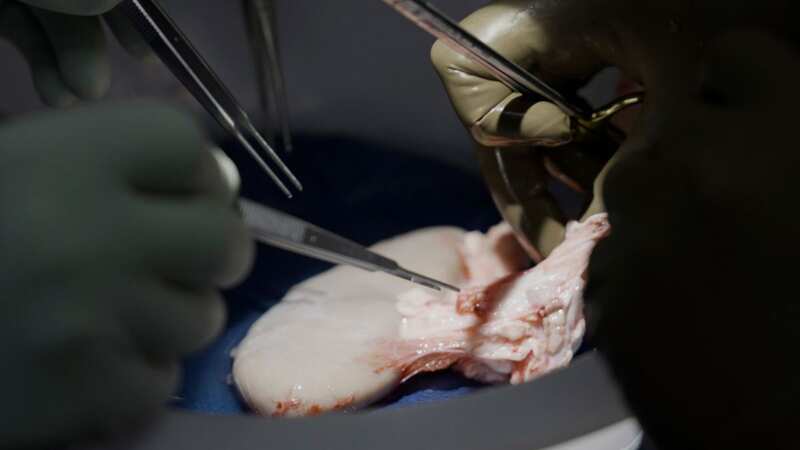 New York University Langone Health surgeons successfully transplanted a pig kidney into a brain-dead man (Image: AP)