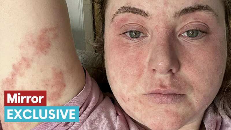 Lily was left with angry skin and in pain after getting £1,000 veneers (Image: Lily Lindsay / SWNS)