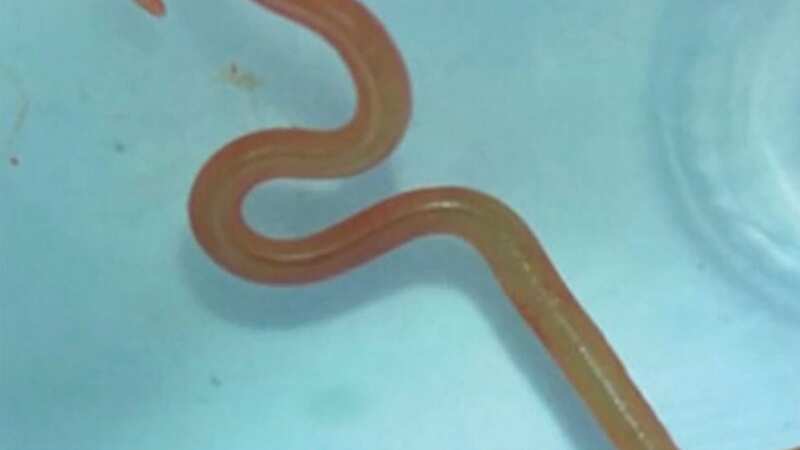 The 8cm parasite, normally found in Australian carpet pythons, was removed during surgery in a world first (Image: Australian National University)
