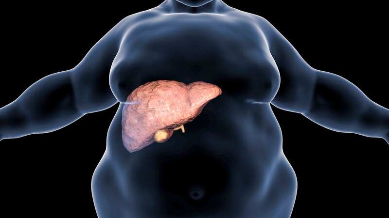Fatty liver is commonly associated with alcohol or metabolic syndrome (diabetes, hypertension and obesity), but can also be due to any one of many causes (Image: Getty Images/Science Photo Library RF)
