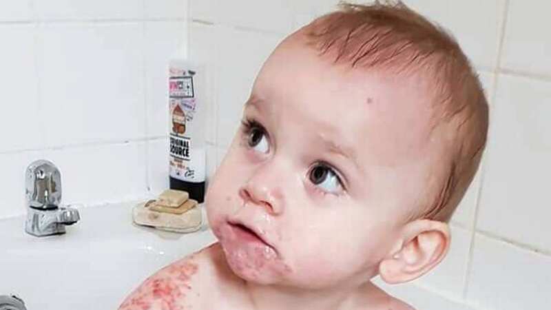 Kaylah Merritt is lucky to be alive after being taken ill with Eczema Herpeticum (Image: Caters News Agency)