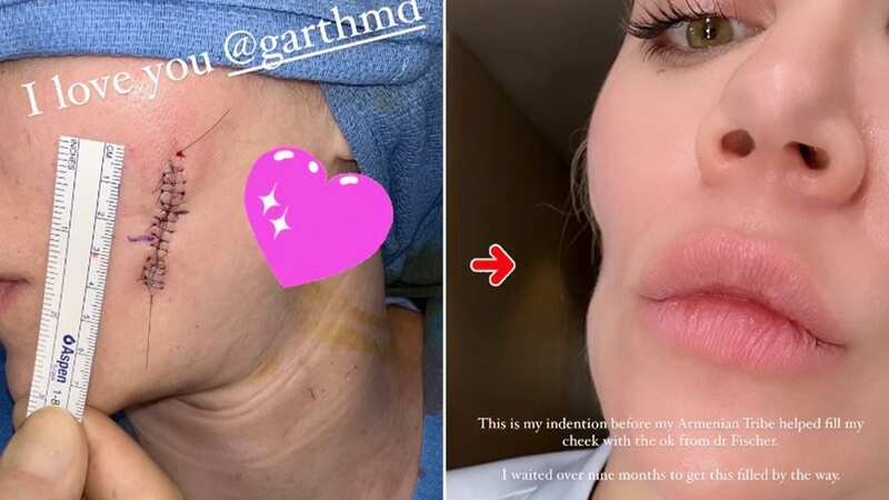 Khloe Kardashian reveals huge indentation on her face after skin cancer removal (Image: khloekardashian/Instagram)