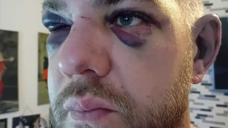 XL Bully campaigner Ben Cźyżyk was attacked by one of the dogs after an owner reportedly instigated the attack (Image: ben.czyzyk.9/Facebook)