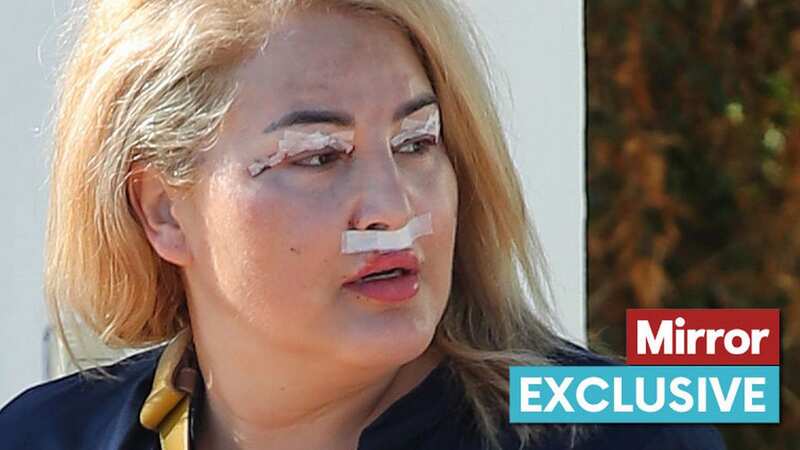 Big Brother icon Nadia seen with stitches on her eyes and bandaged nose