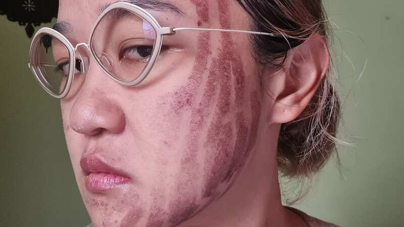 Hours after the treatment strips of dark brown and red burns appeared across her forehead (Image: ViralPress)