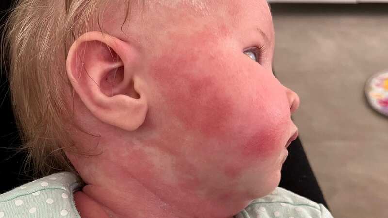 Delilah, now 10 months old, suffered from painful eczema across her body