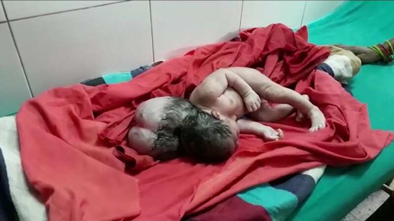 An unknown medical condition has caused the infant to be born with 