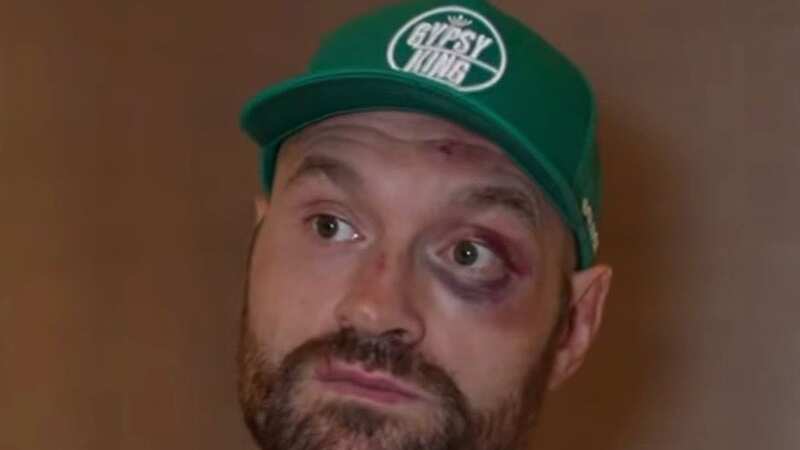 Tyson Fury shows off black eye and bruised face from Francis Ngannou fight