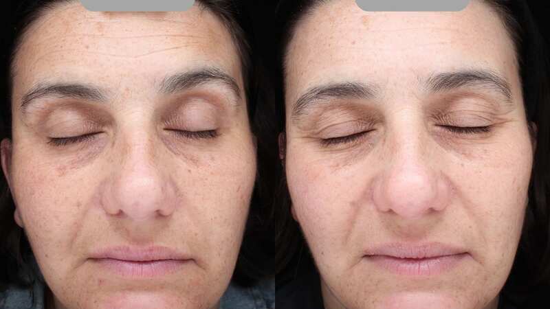 Wrinkles are less defined after 12 weeks (Image: Ingenious Beauty)