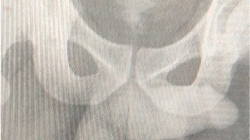 A horrific X-ray showed the extent of the damage (Image: Urology Case Reports)