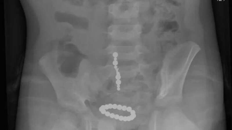 A young girl had to go to hospital after she swallowed magnets (Image: MEN MEDIA)