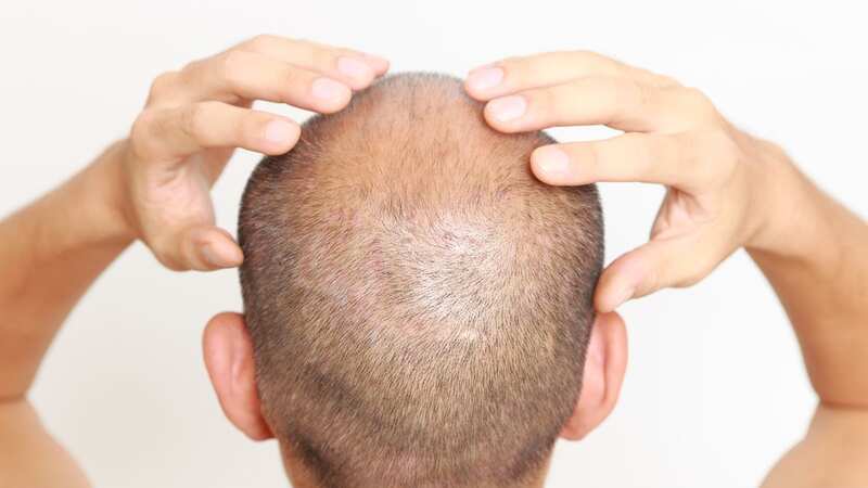 The common grocery could double up as a hair loss prevention hack (Image: Getty Images/iStockphoto)
