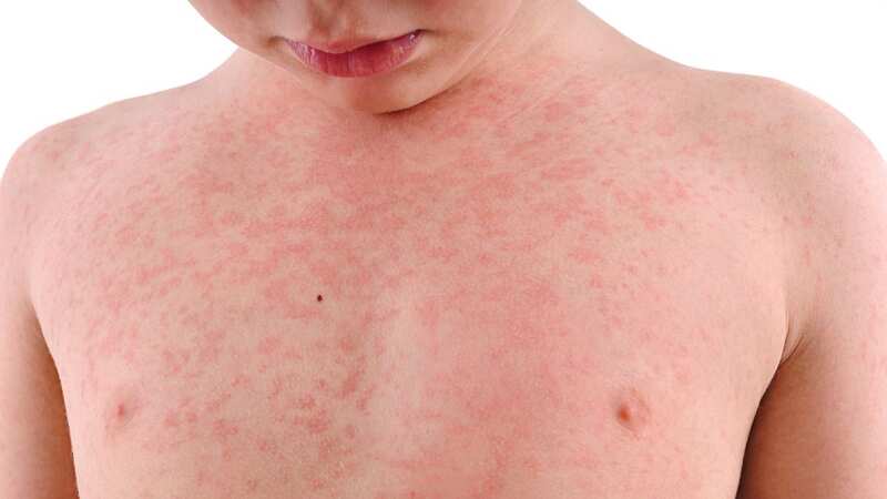 Measles produces a distinctive rash across the body (stock image) (Image: Getty Images/iStockphoto)