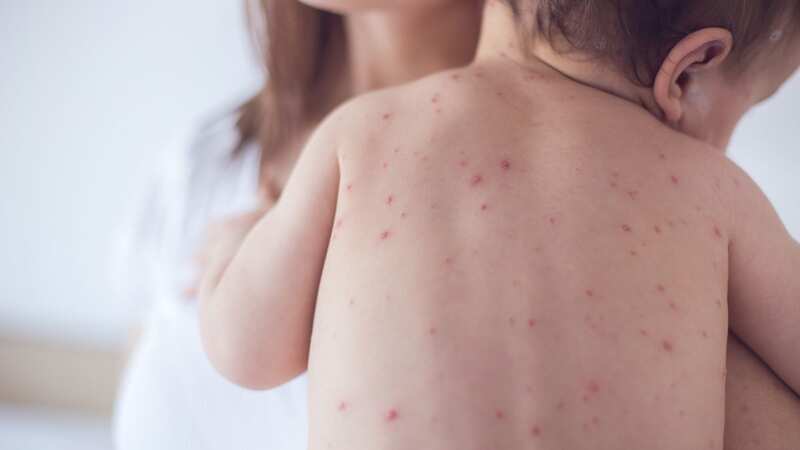 A child with chicken pox (Image: Getty Images/iStockphoto)