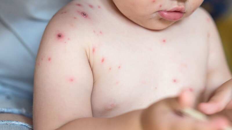 Front view image of baby girl with chickenpox rash (Image: Getty Images)