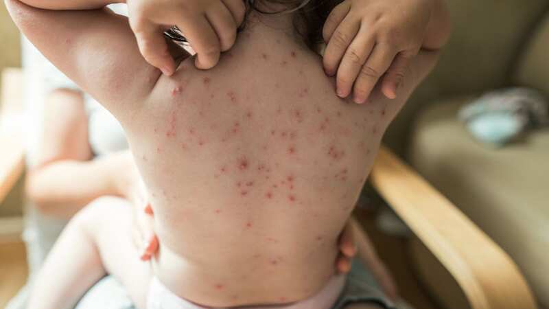 The tell-tale rash of a youngster with chickenpox. (Image: Getty Images)