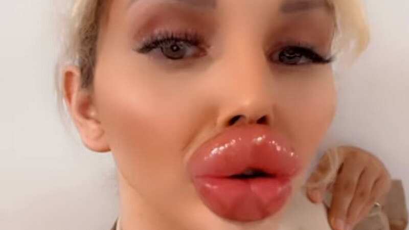 Model Vienna Wuerstel shows off her large lips (Image: CEN)