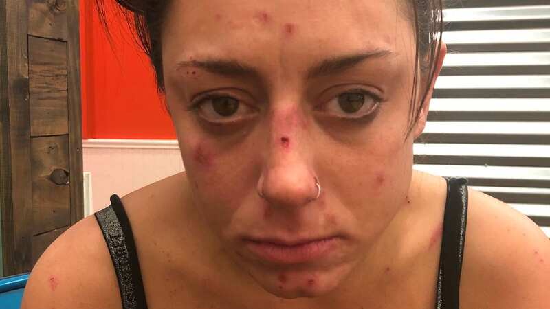 Cara explains how meth-induced psychosis saw her convinced her skin was covered in bugs, causing her to scratch herself (Image: cara.a.tatarelli/Instagram)