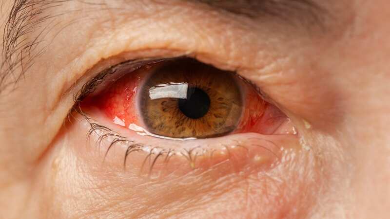 Eye irritation, "red eye" and chronic conjunctivitis are possible symptoms of eye cancer (Image: Getty Images)