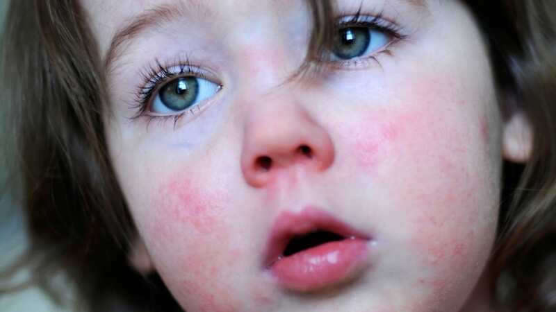 A young girl with scarlet fever (stock image) (Image: Getty Images)