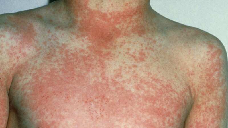 Scarlet fever can cause a bumpy rash (Image: NHS)