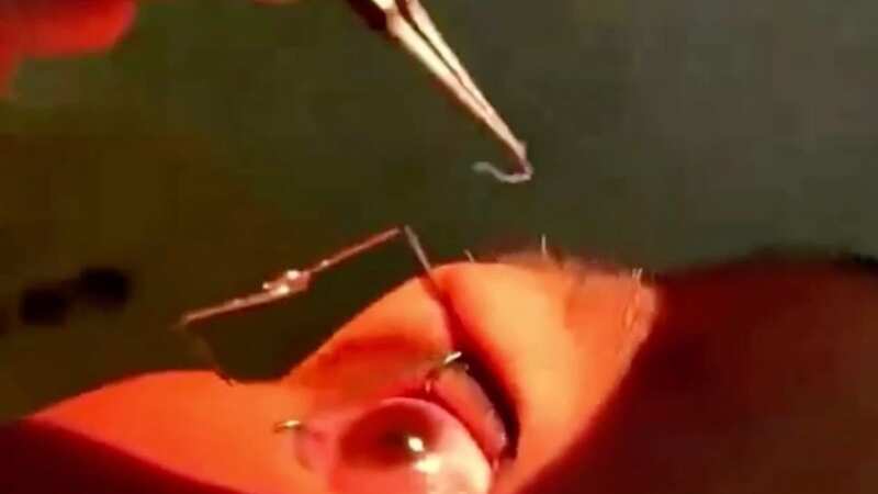The doctors removing the worms from a woman’s eyes (Image: Jam Press Vid)