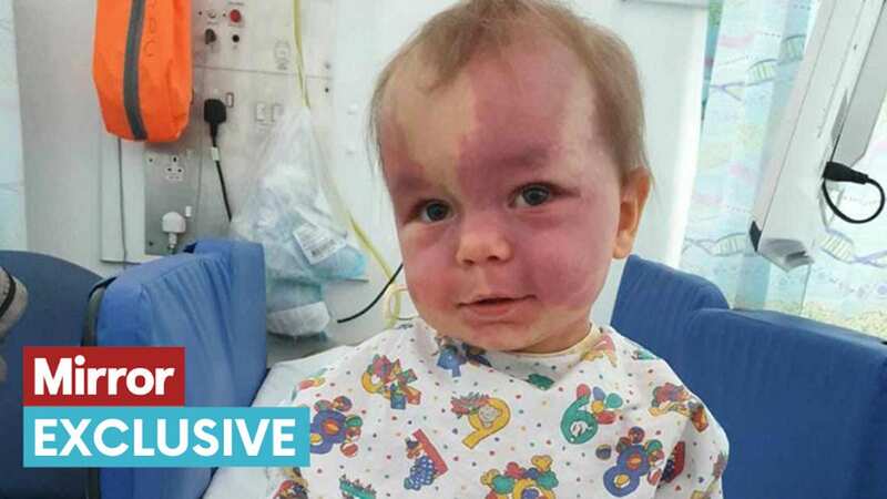 Lily was diagnosed with Sturge Weber Syndrome, a rare neurological disorder, as a baby