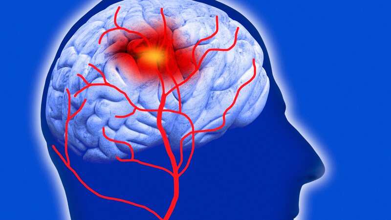 A human brain shows a stroke occurrence (Image: Getty Images/Science Photo Library RF)
