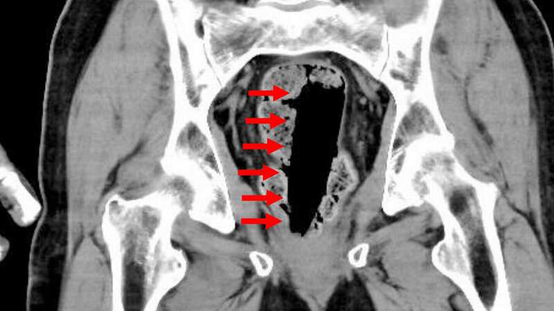 CT scans revealed that the unnamed man had a glue container inside his anus measuring 35x35x120mm (Image: Jam Press)