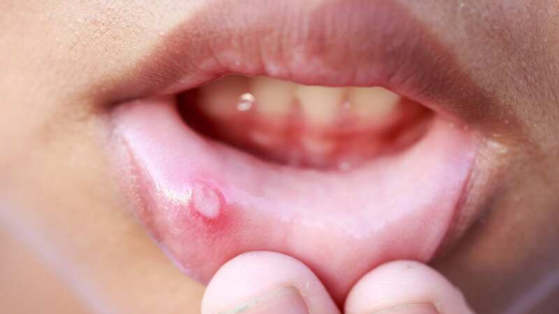 Ulcers are common and shouldn