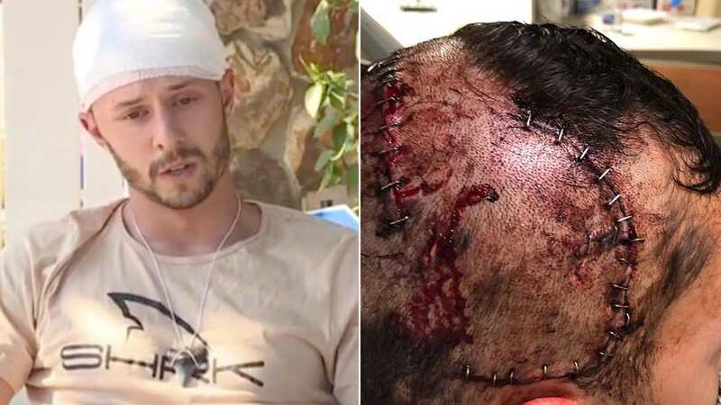 Jeffrey Heim was bitten in the head by an alligator (Image: shrkco/Instagram)