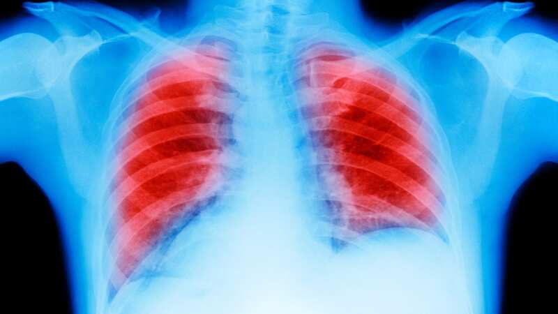 Lung cancer is one of the most common types of cancer in the UK (Stock photo) (Image: Getty Images)