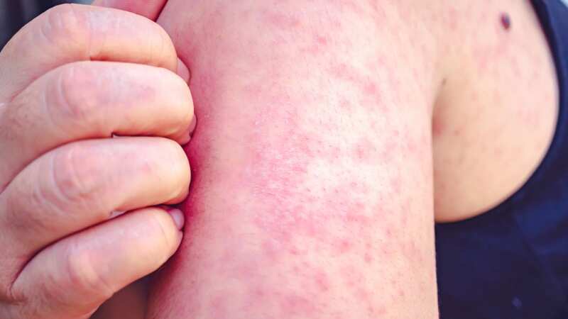 Measles cases are on the rise (Image: Getty Images/iStockphoto)