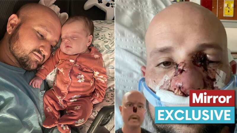 Condition forces dad to have nose removed leaving body so weak a sneeze is fatal
