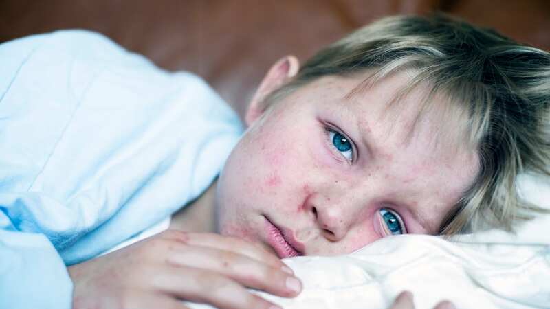 The UK has lost its measles-free status and England is now in the grip of a national outbreak (Image: Getty Images)