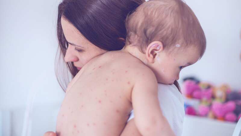 A ‘national health incident’ has been declared amid surging measles cases (Image: Getty Images)