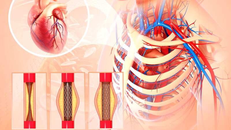Dr Miriam Stoppard has been signing the praises of heart stents (Image: Getty Images/Science Photo Library RF)