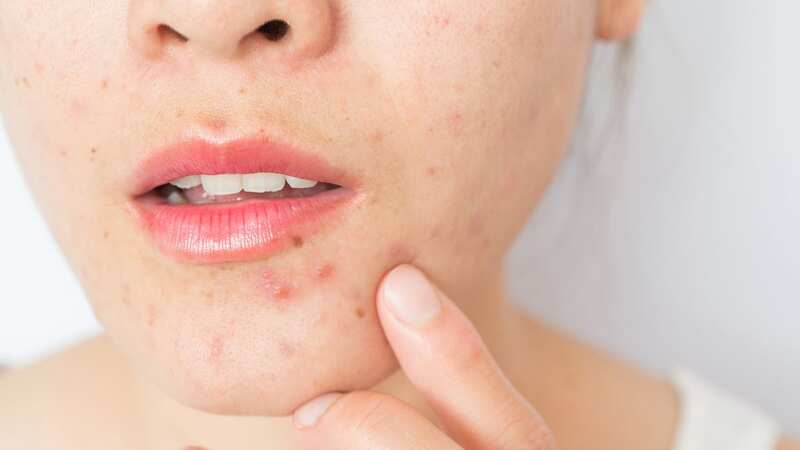 There are some natural remedies to help tackle acne redness and scarring (stock photo) (Image: Getty Images)