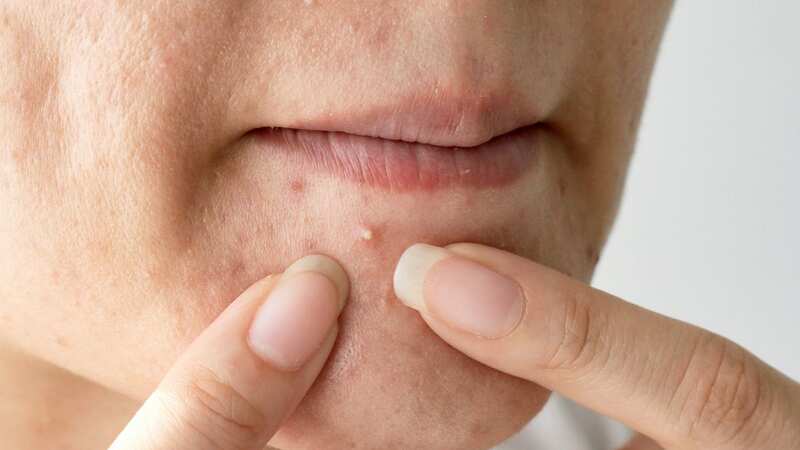 Skin can become drier and dehydrated in winter and many people may noticed spots starting to appear (Image: Getty Images/iStockphoto)