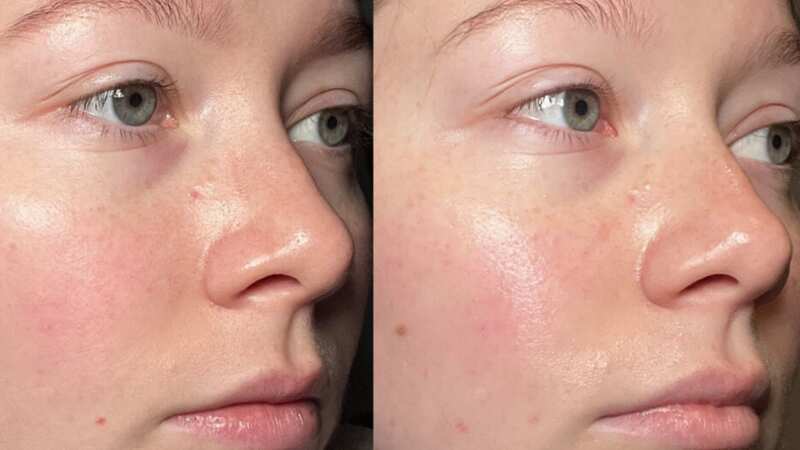Before using the latest Revolution serum, and after four weeks of applying (Image: Revolution)