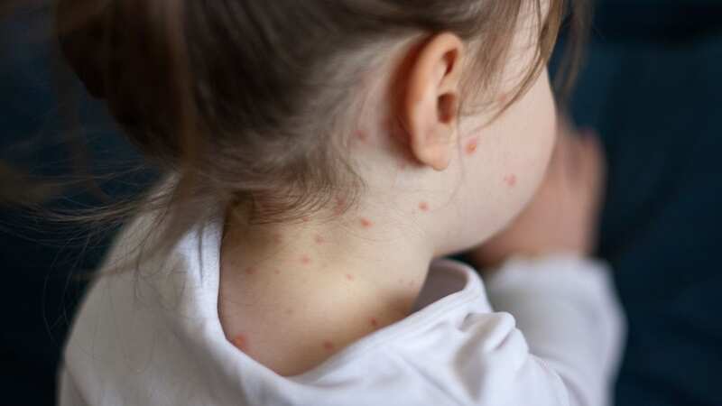 Measles cases in the UK have tripled in just a week (stock image) (Image: Getty Images)
