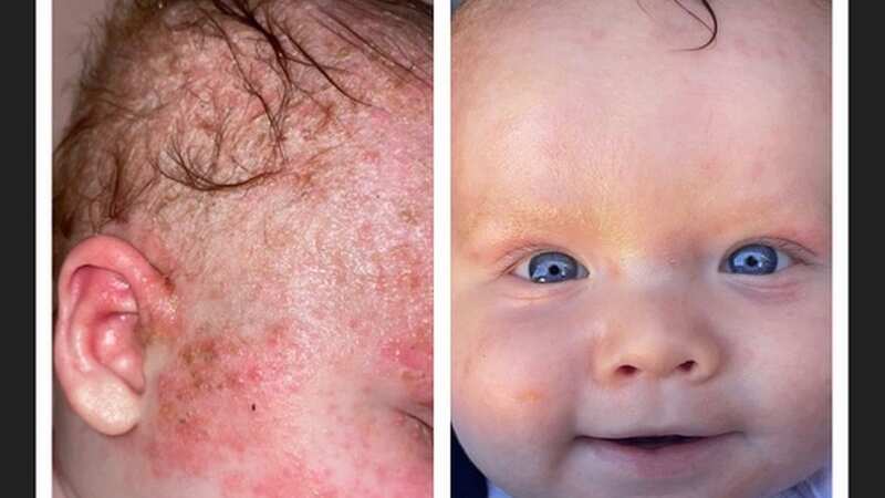 Baby before and after using skin balm (Image: Charlette Forster)