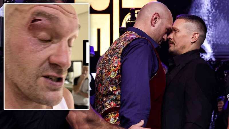 Tyson Fury has revealed he needed 11 stitches after a sparring injury (Image: TOLGA AKMEN/EPA-EFE/REX/Shutterstock)