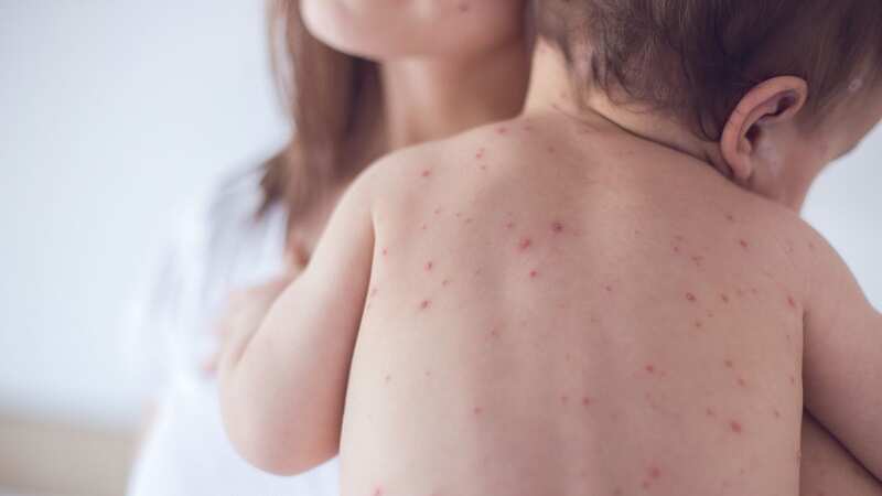 Of the seven symptoms, one of the most distinctive is the rash measles causes (stock image) (Image: Getty Images/iStockphoto)