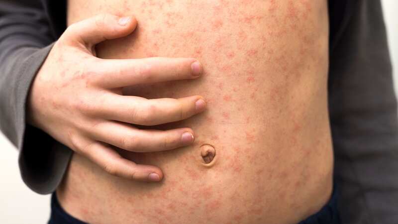 Measles is on the rise (Image: Getty Images)