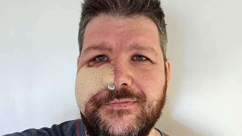 The dad was forced to collect chunks of his own face off the floor in the hope they could be reattached