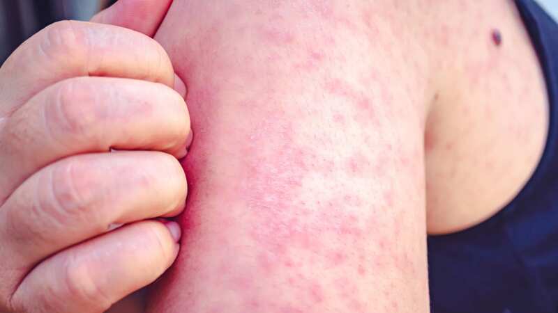 Data shows measles cases have been recorded across all regions of England (Image: Getty Images)