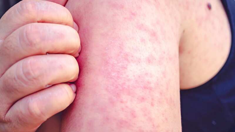 Measles cases are soaring across Europe, including the UK, prompting a warning from WHO doctors (Image: Getty Images)